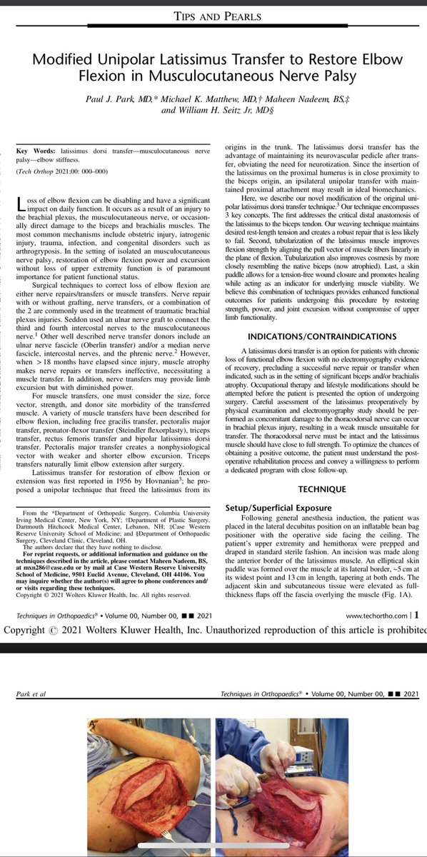 Maheen_Nadeem22's tweet photo. Paper hot off the press @TechinOrtho:
We run through a creative way to use latissimus to return #elbow flexion in a Parsonage Turner patient. This was a fun one to work on, grateful I could be involved! #orthotwitter #research #UpperExtremity 
https://t.co/YgOmex1HyE https://t.co/W3ji2YqV87