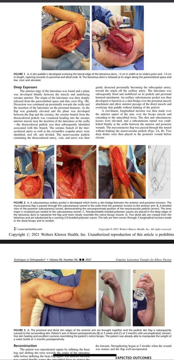 Maheen Nadeem (@maheen_nadeem22) on Twitter photo Paper hot off the press <a href="/TechinOrtho/">Techniques in Orthopaedics</a>:
We run through a creative way to use latissimus to return #elbow flexion in a Parsonage Turner patient. This was a fun one to work on, grateful I could be involved! #orthotwitter #research #UpperExtremity
bit.ly/3yGcVNi Paper hot off the press <a href="/TechinOrtho/">Techniques in Orthopaedics</a>:
We run through a creative way to use latissimus to return #elbow flexion in a Parsonage Turner patient. This was a fun one to work on, grateful I could be involved! #orthotwitter #research #UpperExtremity
bit.ly/3yGcVNi