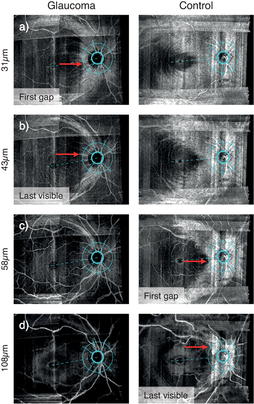 ARVOtvst's tweet photo. New and free to read: "A Simple Subjective Evaluation of Enface #OCT Reflectance Images Distinguishes #Glaucoma From Healthy Eyes.”
Check it out: https://t.co/JBFsI3zDwX @UoBOptometry @LeedsHospitals #OCT #imaging #OpenAccess #ophthalmology https://t.co/b8xixiPQWV