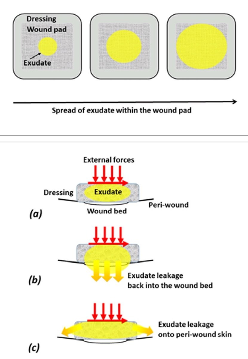 AmitGefen's tweet photo. Absorption of #exudate in a #wound #dressing - what can go wrong? See our latest @WoundsIntnl paper:

https://t.co/xIVDx7tdqm

@EPUAP1 @TheNPIAP @APTFeridas @WoundHeal
@stints_eu @NSWOC https://t.co/wYB2i6XuQY
