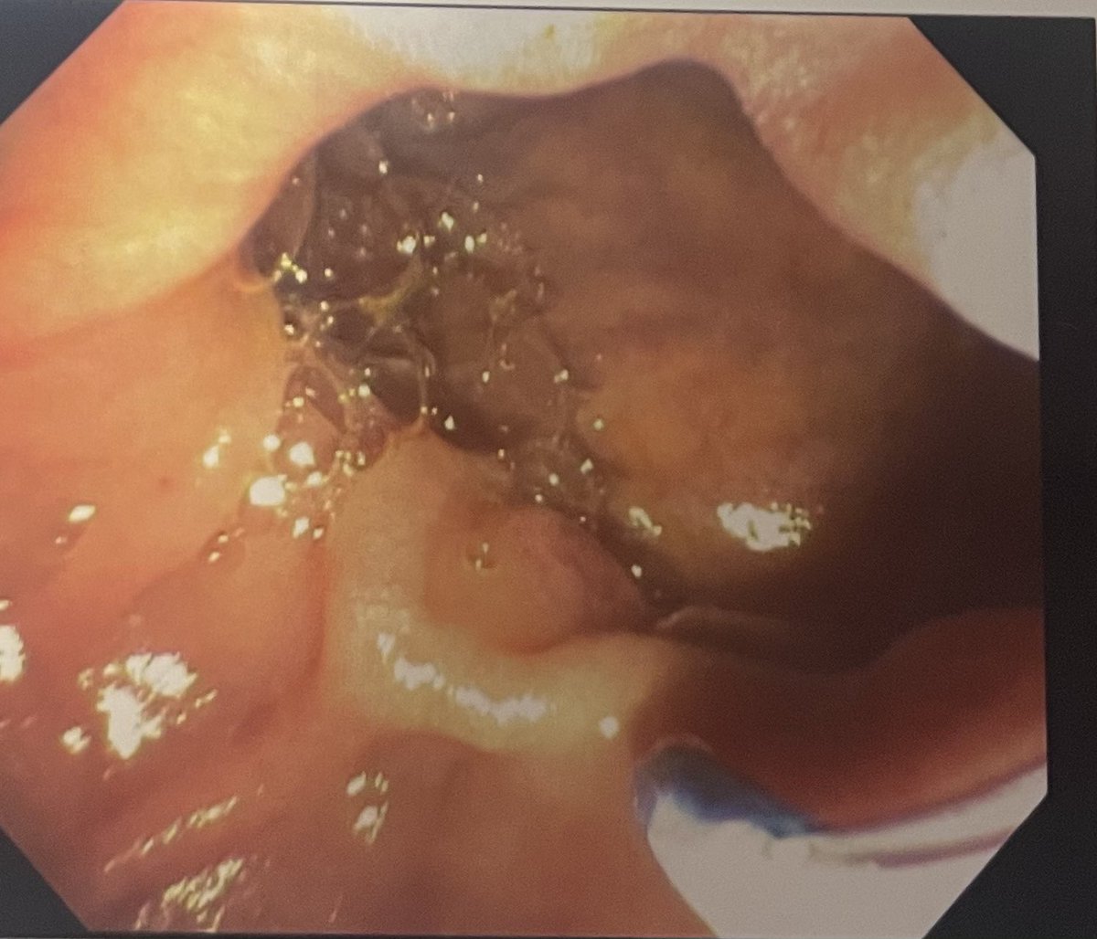 Dalbir Sandhu, MD, FACG, FASGE tweet media