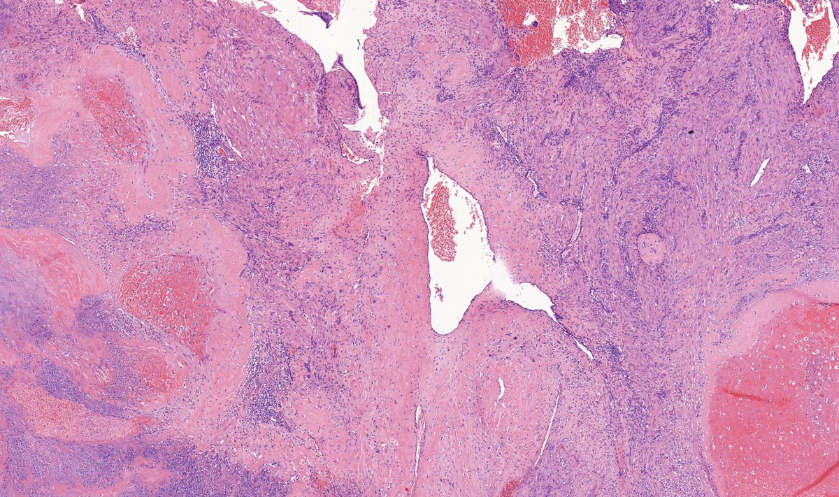 TristanRutland7's tweet photo. Secondary postpartum haemorrhage
(2 weeks postpartum)
#Gynpath #Obstetrics #pathwtitter #medtwitter https://t.co/EwCfztP3Rl