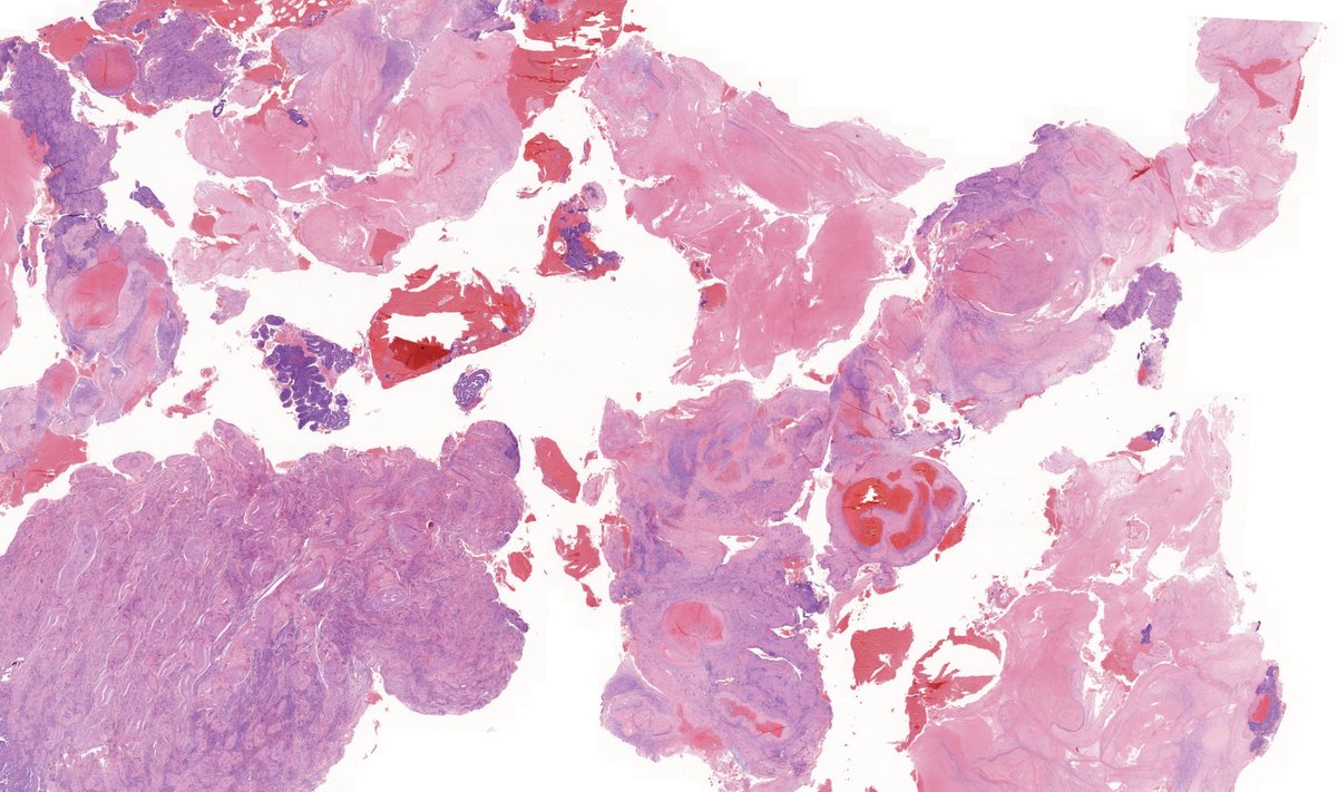TristanRutland7's tweet photo. Secondary postpartum haemorrhage
(2 weeks postpartum)
#Gynpath #Obstetrics #pathwtitter #medtwitter https://t.co/EwCfztP3Rl