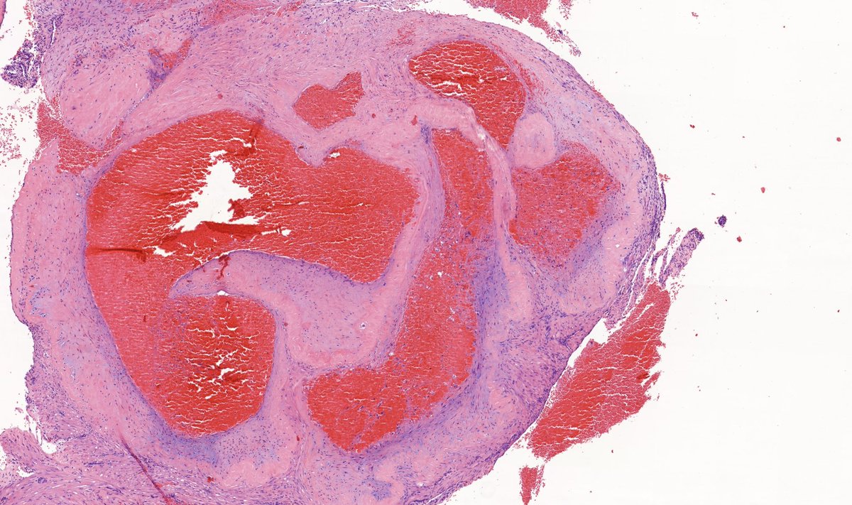 TristanRutland7's tweet photo. Secondary postpartum haemorrhage
(2 weeks postpartum)
#Gynpath #Obstetrics #pathwtitter #medtwitter https://t.co/EwCfztP3Rl