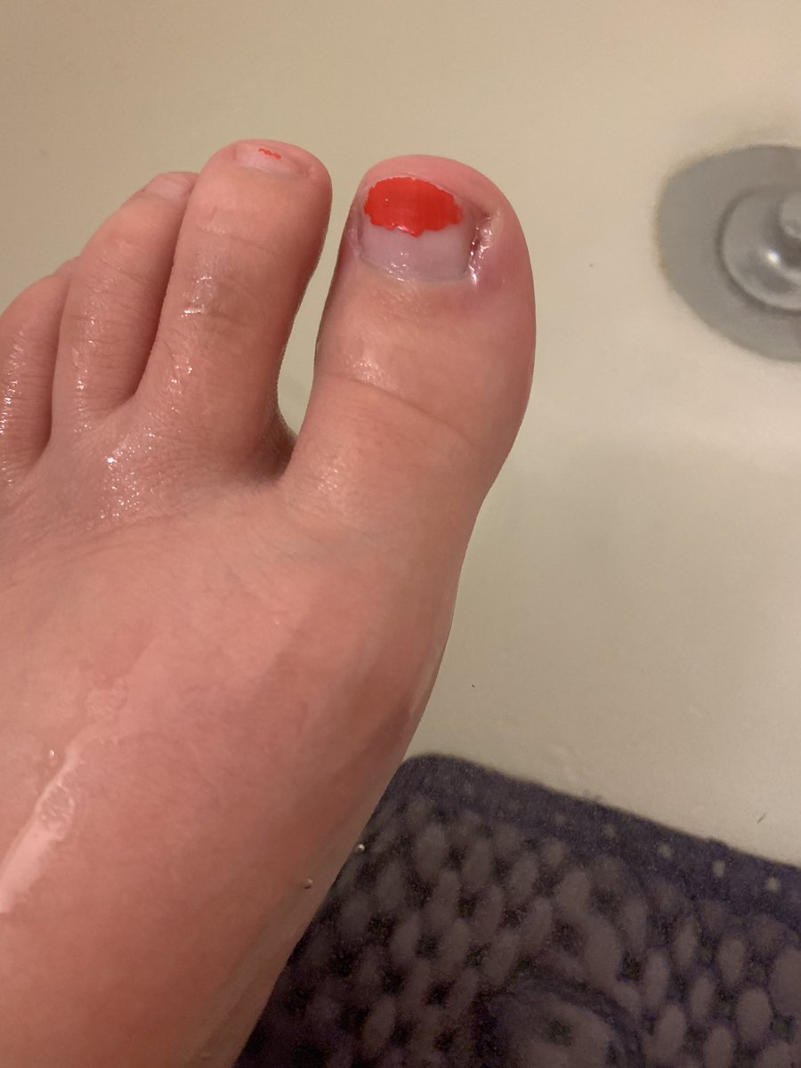 tinyhandsmcgee's tweet image. Well there goes my shot at selling feet pics. Also welcome to my epsom salt soak