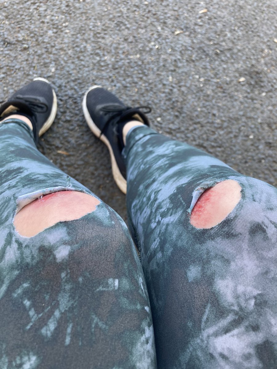 RawWatfordEdge's tweet image. 10 days after my birthday I seem to have had a fall 😭 #old #decrepit #ow