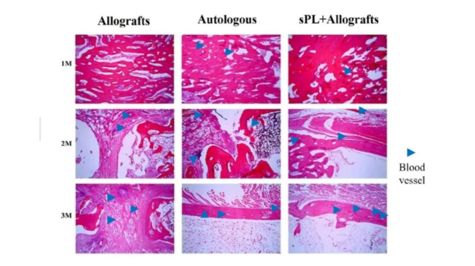 ArtifOrgans's tweet photo. Reparative effect of super active #PlateletLysate combined with #Allogeneic bone for large #BoneDefects
#OnlineFirst👉https://t.co/55pxAWtUpf
#China 🇨🇳
#TissueEngineering #BoneDefect https://t.co/kowFdfwXo9