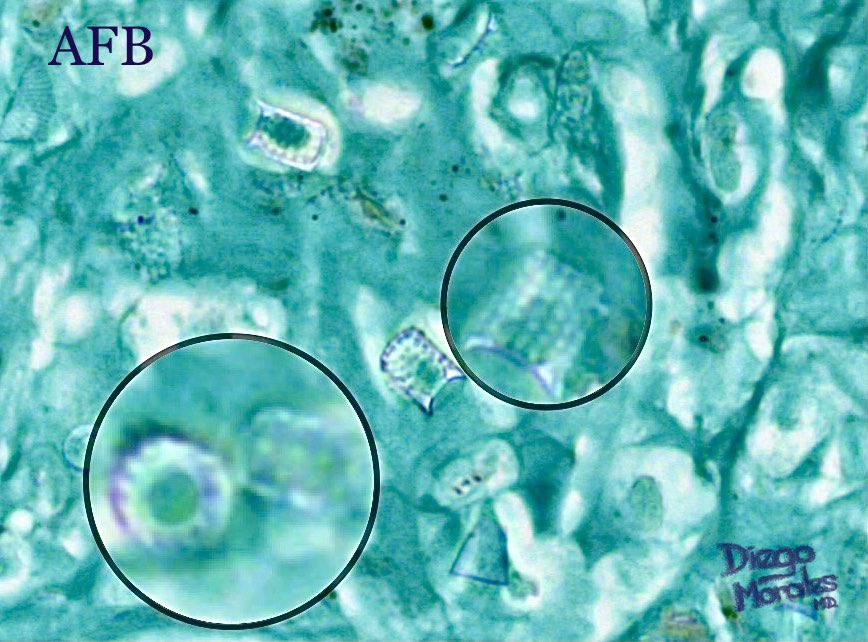 Sarcoid-like granulomatous panniculitis in an adult. Can you find out what the cause is?
#pathology #dermatopathology
 #JoyForMorfology #FreudeAnDerMorphologie #pathfulness #pathology #dermpath #patologia