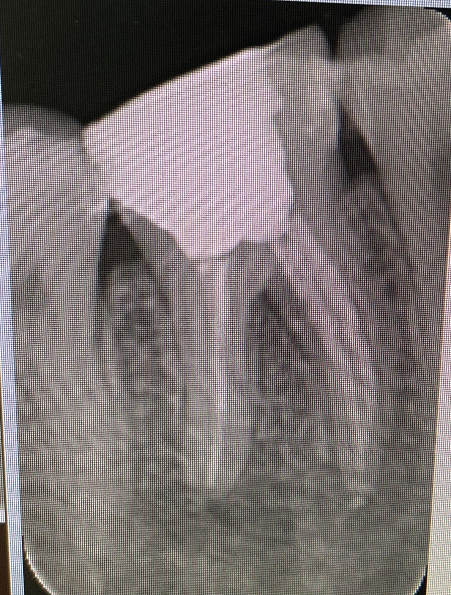 drfahadammar's tweet photo. Root canal treatment for tooth #46 in one visit 👌
#صباح_الخير https://t.co/oIKyTosfMC