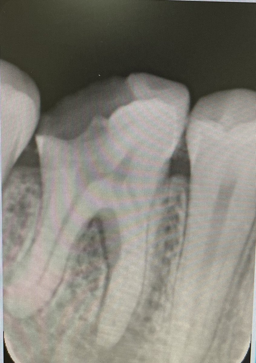 drfahadammar's tweet photo. Root canal treatment for tooth #46 in one visit 👌
#صباح_الخير https://t.co/oIKyTosfMC
