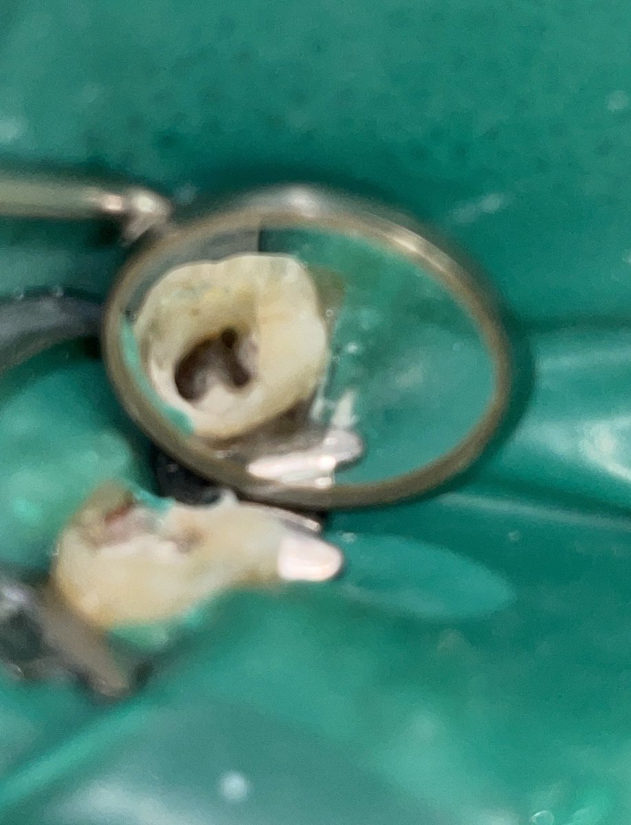 drfahadammar's tweet photo. Root canal treatment for tooth #46 in one visit 👌
#صباح_الخير https://t.co/oIKyTosfMC