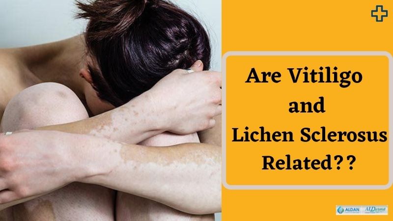 aldancare's tweet photo. Are Vitiligo &amp; Lichen Sclerosus Related?? Find the answer to this question here👉https://t.co/y8JGs29QrY

#vitiligoawareness #vitiligo #lichensclerosus #lichen #skindisorders #skindisease #dermatology #dermatologicallytested #alderma #aldanhealthcare https://t.co/xlYX0I3Ytz