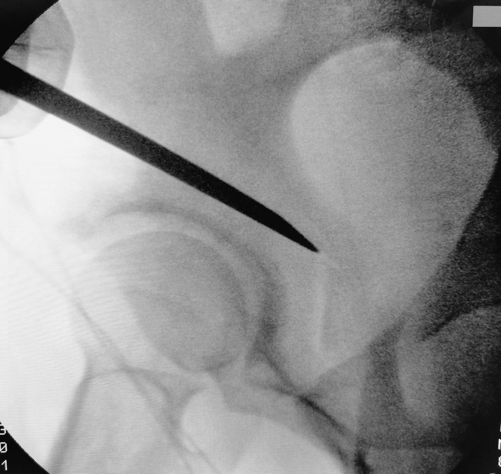 cirugiadecadera's tweet photo. La Osteotomía periacetabular sigue siendo el mejor tratamiento disponible para la #Displasia de cadera sintomática. Los resultados son muy buenos en >90%. El éxito radica en realizar un procedimiento lo menos agresivo posible y en la correcta orientación del fragmento #icatme . https://t.co/CGfny3wKhS