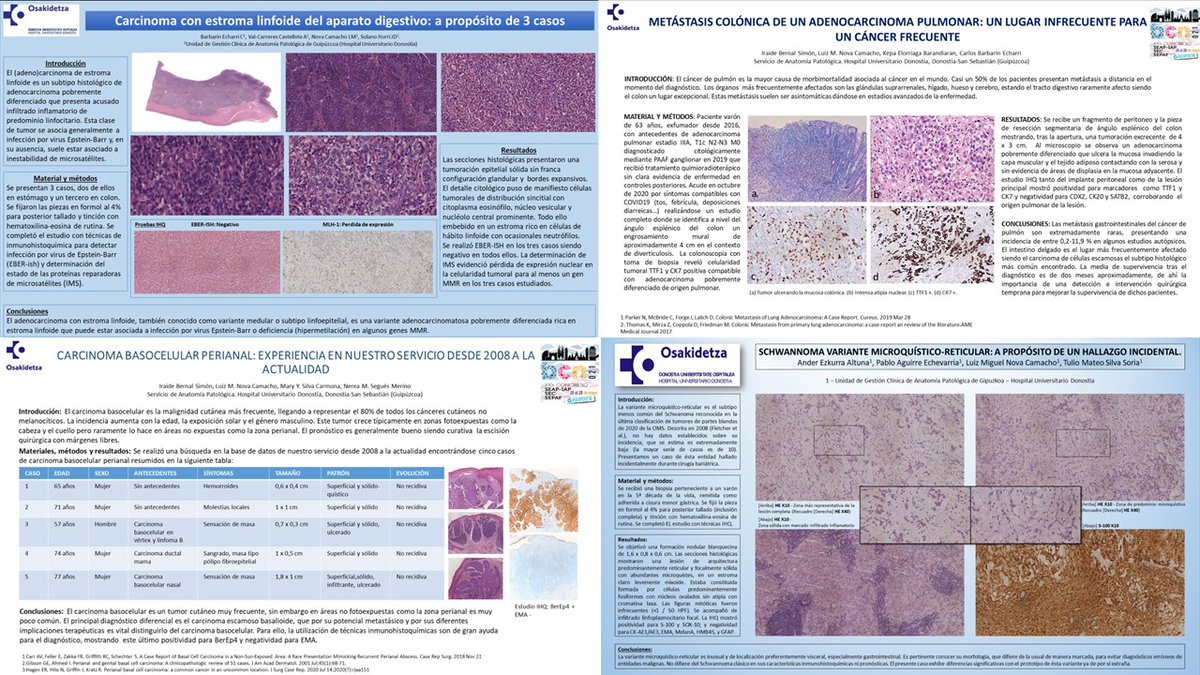 Luiz M. Nova-Camacho, MD (@luizmigueln) on Twitter photo Contribución del Hospital Universitario Donostia al congreso #SEAP2021B 🔬
Contribution of the University Hospital Donostia to the SEAP national congress
#GIpath #GUpath #hemepath #breastpath #cytopath #neuropath #dermpath #lungpath
<a href="/EzkurraMd/">AnderEzkurraMD</a> <a href="/TulioMSilvaS/">Tulio Silva, MD</a> <a href="/juanpgarcesm/">Juan Pablo Garces, MD</a> & Col. Contribución del Hospital Universitario Donostia al congreso #SEAP2021B 🔬
Contribution of the University Hospital Donostia to the SEAP national congress
#GIpath #GUpath #hemepath #breastpath #cytopath #neuropath #dermpath #lungpath
<a href="/EzkurraMd/">AnderEzkurraMD</a> <a href="/TulioMSilvaS/">Tulio Silva, MD</a> <a href="/juanpgarcesm/">Juan Pablo Garces, MD</a> & Col.