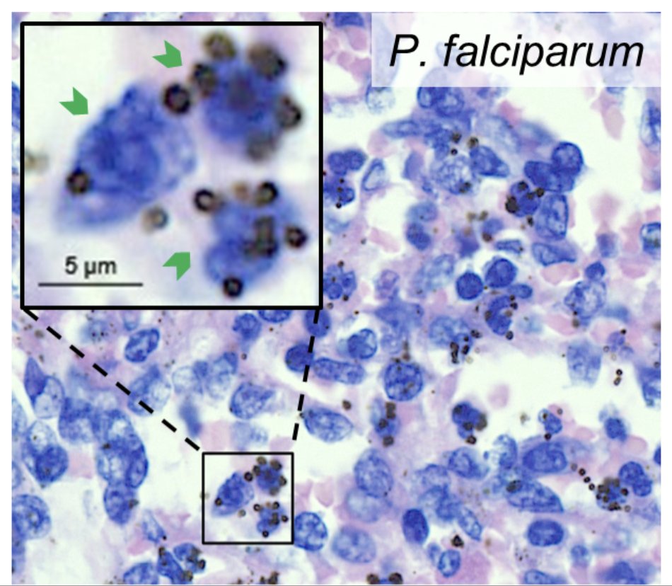 #Malaria #parasites hide in the spleen, alive and outnumbering parasites in the blood. Spectacular discovery from splenectomized patients in Papua journals.plos.org/plosmedicine/a… and nejm.org/doi/full/10.10…