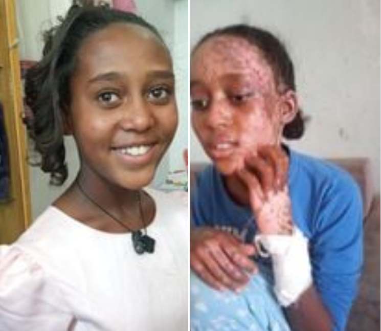 geb_hai's tweet photo. Victim of an internationally prohibited chemical attack by #EthiopianArmy &amp; #EritreanTroops in a village near Feresmai town, Central zone of #Tigray. 
@SecBlinken @USAmbUN @ChrisCoons @jakejsullivan @SenateForeign @SenatorCardin @SenatorRisch @RandPaul @ChrisVanHollen @SecBlinken https://t.co/PQ8xHIYA4x