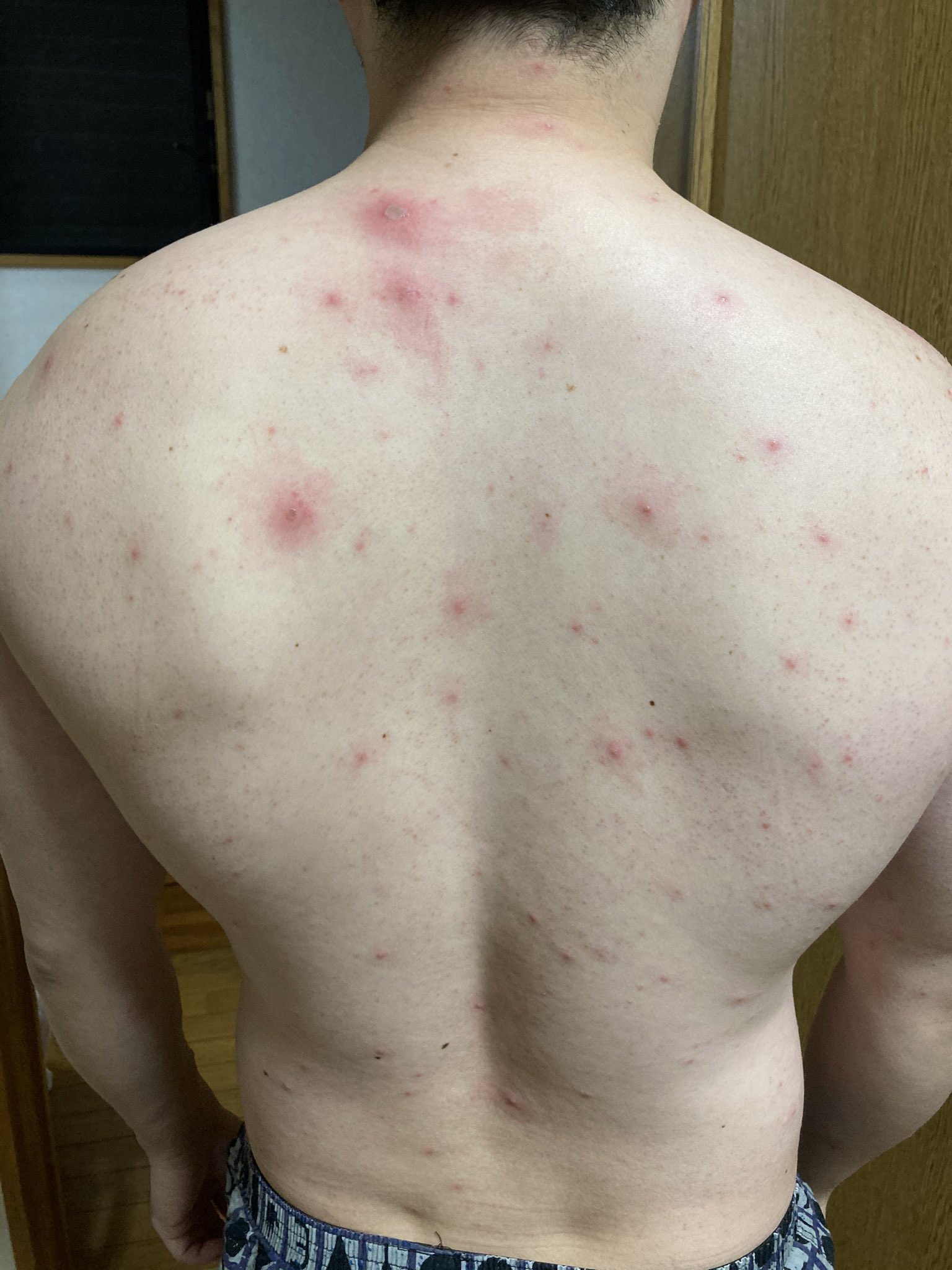 ノクテュルヌ 大人になってからの水痘 いわゆる水疱瘡になりまんた 顔と頭が1番キツいです T Co 8sk1nghoyd Twitter
