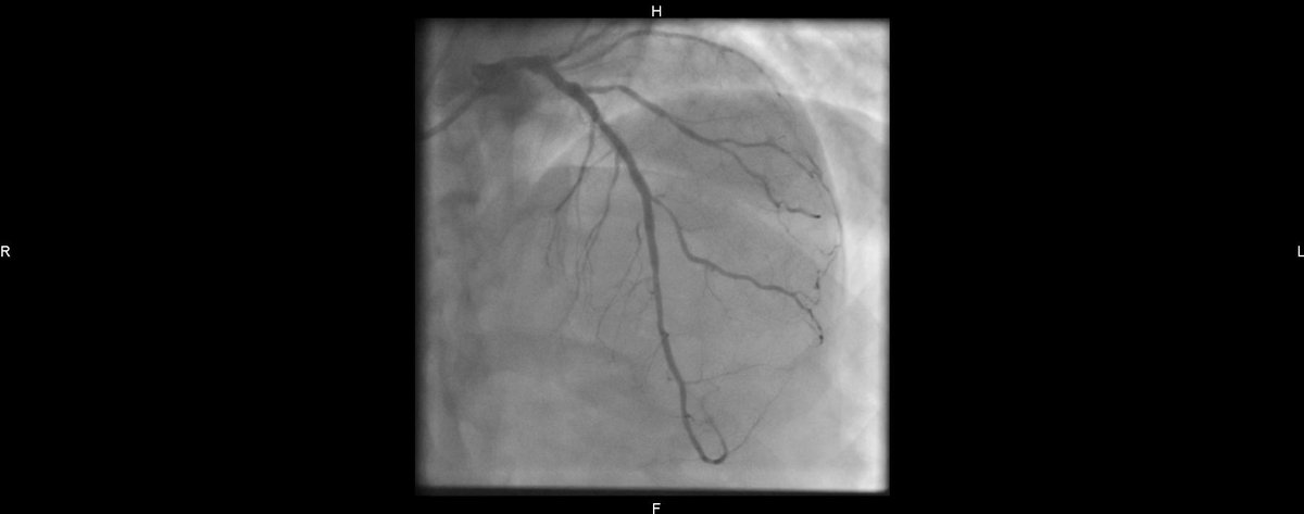 Congrats to @V_Rubimbura &amp; Dr Alexandre Berger for 1st use of #OptoWire III in Switzerland at Hôpital de Morges.

Patient with a severely calcified lesion on proximal LAD treated with ShockWave and subsequent stent implantation with final negative dPR pullback.
<a href="/AllInCoroPhy/">All In Coronary Physiology</a>