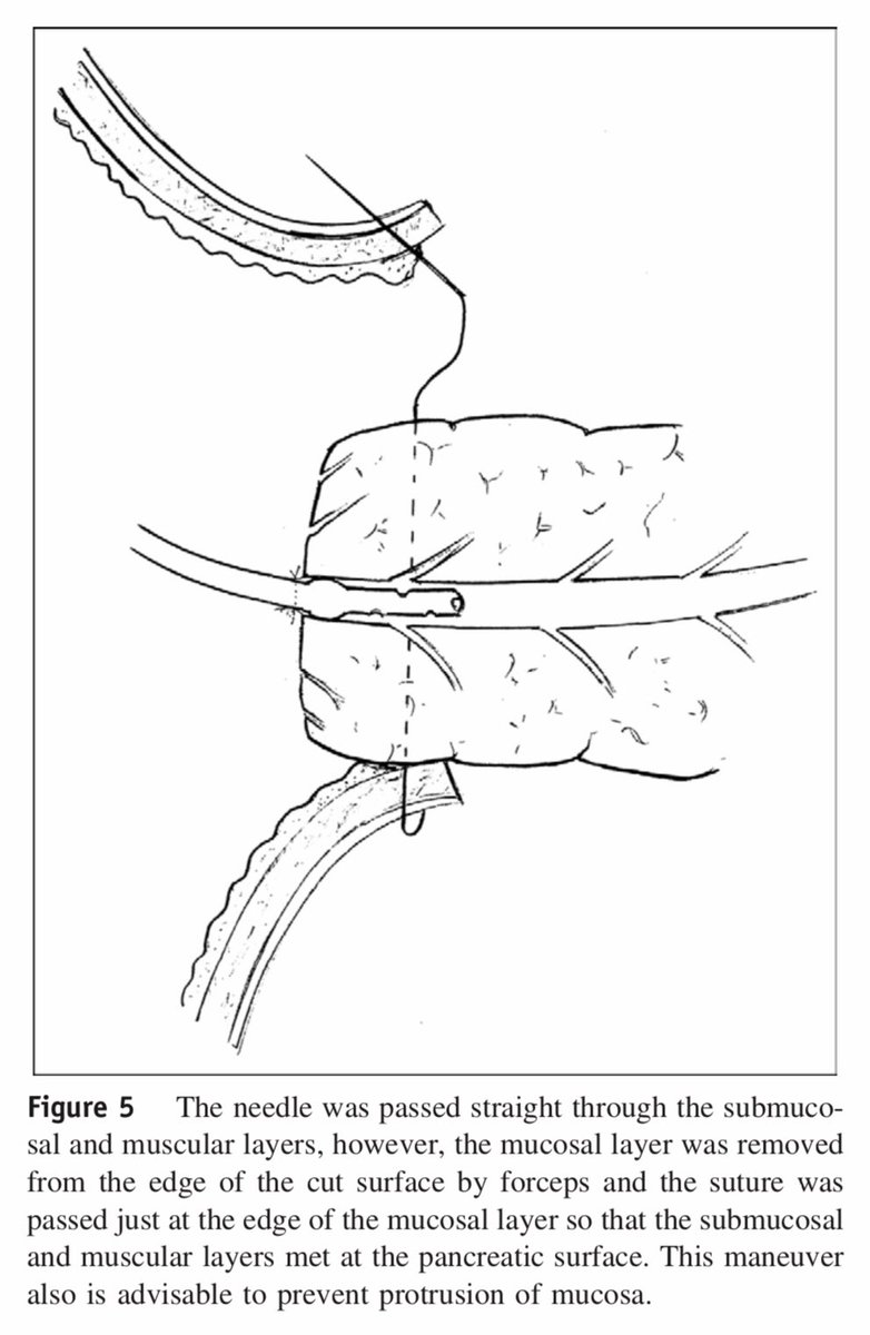 A simple and safe anastomosis in pancreaticogastrostomy using mattress sutures ⤵️! #SoMe4Surgery <a href="/herbchen/">herb chen</a> <a href="/pferrada1/">Paula Ferrada MD FACS FCCM MAMSE</a> <a href="/PipeCabreraV/">Dr Luis Felipe Cabrera Vargas MD FACS</a> @cirbosque <a href="/SocietyofBAS/">Society of Black Academic Surgeons</a> <a href="/DChu80/">Daniel I-Hsin Chu | 朱以信</a> <a href="/SWexner/">Steven D Wexner MD, PhD</a> <a href="/juliomayol/">Julio Mayol</a> @MISIRG1 <a href="/WomenSurgeons/">WomenSurgeons</a> <a href="/BrenessaL/">Brenessa Lindeman, MD, MEHP</a> <a href="/DanaTelem/">Dana Telem</a>