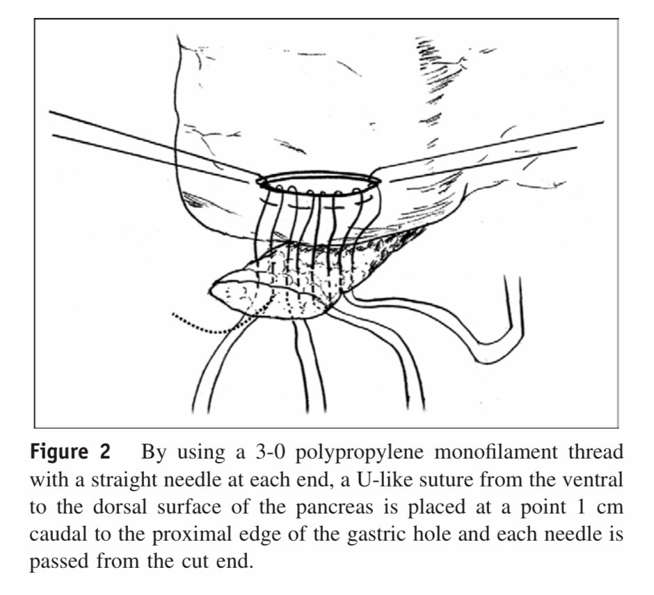 AmJSurgery's tweet photo. A simple and safe anastomosis in pancreaticogastrostomy using mattress sutures ⤵️! #SoMe4Surgery @herbchen @pferrada1 @PipeCabreraV @cirbosque @SocietyofBAS @DChu80 @SWexner @juliomayol @MISIRG1 @WomenSurgeons @BrenessaL @DanaTelem https://t.co/222QUM05nU
