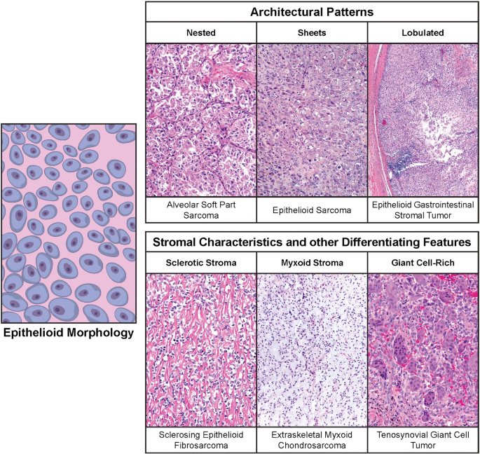 thejourneymate's tweet photo. Common Soft Tissue Tumors by Morphology: In Illustrations 🔬
https://t.co/s7PR7tgdD2 https://t.co/6z3fT5PHmk