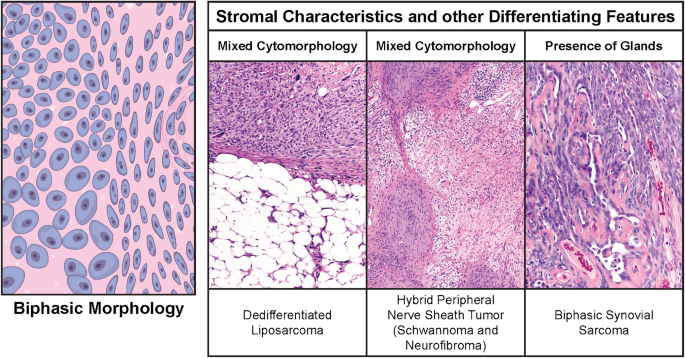thejourneymate's tweet photo. Common Soft Tissue Tumors by Morphology: In Illustrations 🔬
https://t.co/s7PR7tgdD2 https://t.co/6z3fT5PHmk