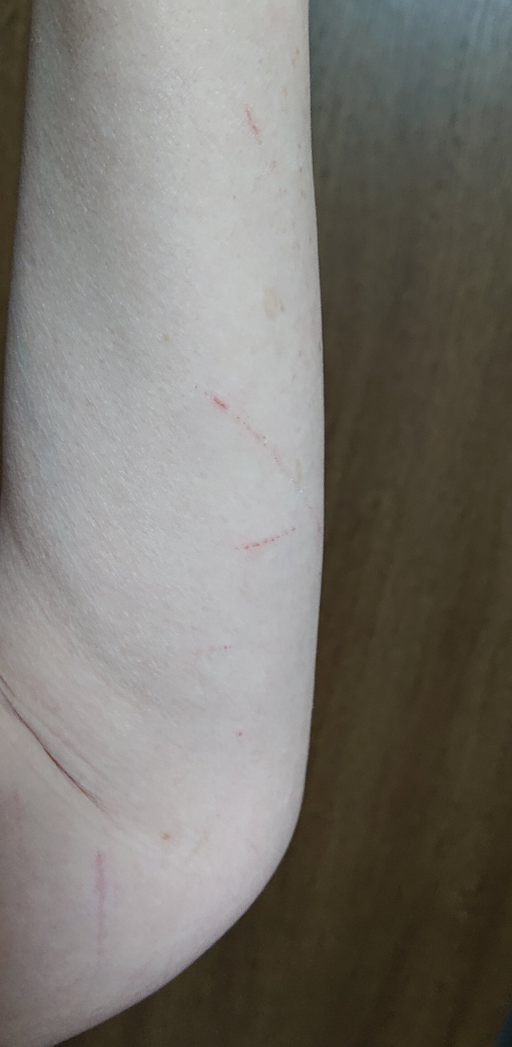 Toni Da Maki 毎日 集団ストーカー の テクノロジー犯罪 により沢山傷付けられますが昨日は両腕を傷付けられた 二の腕の内側にも沢山傷があるけど自分では上手く撮れません 被害記録 T Co Jghfzxquui Twitter