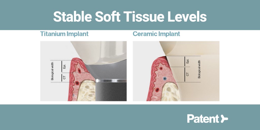 ZirconMedical's tweet photo. Unlike osseointegration, which focuses on the behavior of the bone, Bio-integration is achieved only when all surrounding tissues bond with the implant. For succesful long term results, stable soft and hard tissue levels are critical. For more info visit: https://t.co/kmETCnIGsg https://t.co/UHgKhvB8tm
