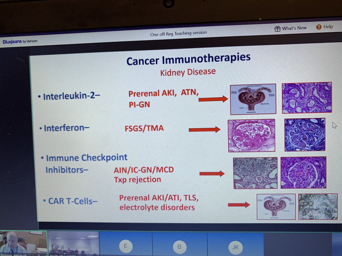 Rosner and colleagues from Virginia joining GSTT ITU and renal on AKI in haem oncology. Interesting cases and review of literature. POC GFR testing in development. Could be game changer...
