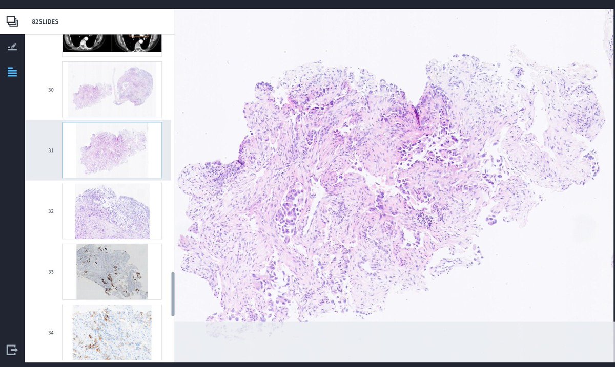 lara_pijuan's tweet photo. Simulación de un comité de tumores entre @hospitaldelmar y @hospital12Oct con #NAVIFYTumorBoard dónde hemos presentado casos de #Cancerdepulmon #RET #ROS1 y #EGFR y de #cancerdemama que no os podéis perder.
Gracias por la invitación y la organización🙏🏻#MarPath #SEAP2021B https://t.co/EJ8GvkIqZI