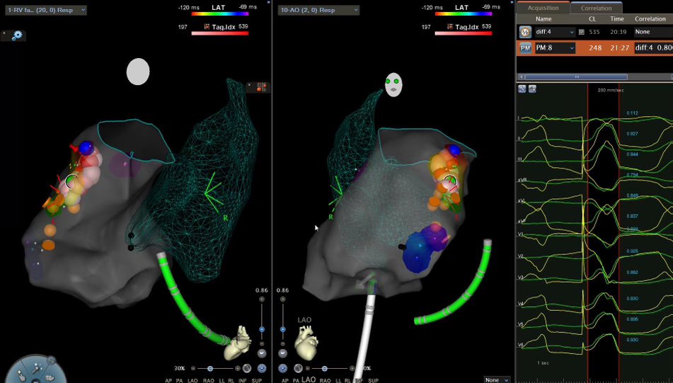 JamesKnellerMD's tweet photo. Tricky anatomy for #PVC migrating along septal RVOT, mapped LVOT but anatomically remote. Couldn’t reach AIV but not behaving like summit. Did we get it?? #biosensewebster #peeps #ep_fellow https://t.co/WLqjWFMUTL