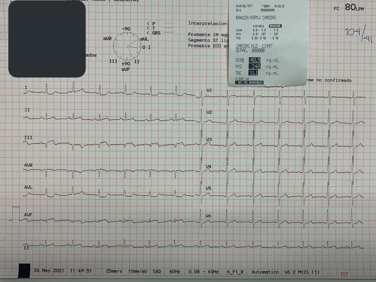 Dr_CSantiago's tweet photo. IAMCEST.
•Pb ARI: Coronaria Derecha.
- ⬆️ST DIII > DII
- ⬇️ST DI y AVL
- S: 90% // E: 71%
- ⬆️ST V3R - V4R
- S:79% // E:100%
#HCSAE #Cardiology https://t.co/rG9EARktp1