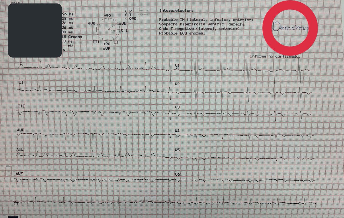 Dr_CSantiago's tweet photo. IAMCEST.
•Pb ARI: Coronaria Derecha.
- ⬆️ST DIII > DII
- ⬇️ST DI y AVL
- S: 90% // E: 71%
- ⬆️ST V3R - V4R
- S:79% // E:100%
#HCSAE #Cardiology https://t.co/rG9EARktp1