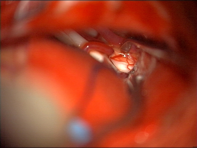 SBase360's tweet photo. The facial nerve origin at the brainstem is closer in proximity to the lower cranial nerves than to the origin of CNVIII. I prefer to expose the facial nerve with a supra-condylar approach in order to get this view. #hemifacialspasm #microvasculardecompression #neurosurgery https://t.co/TtkaxFW34g