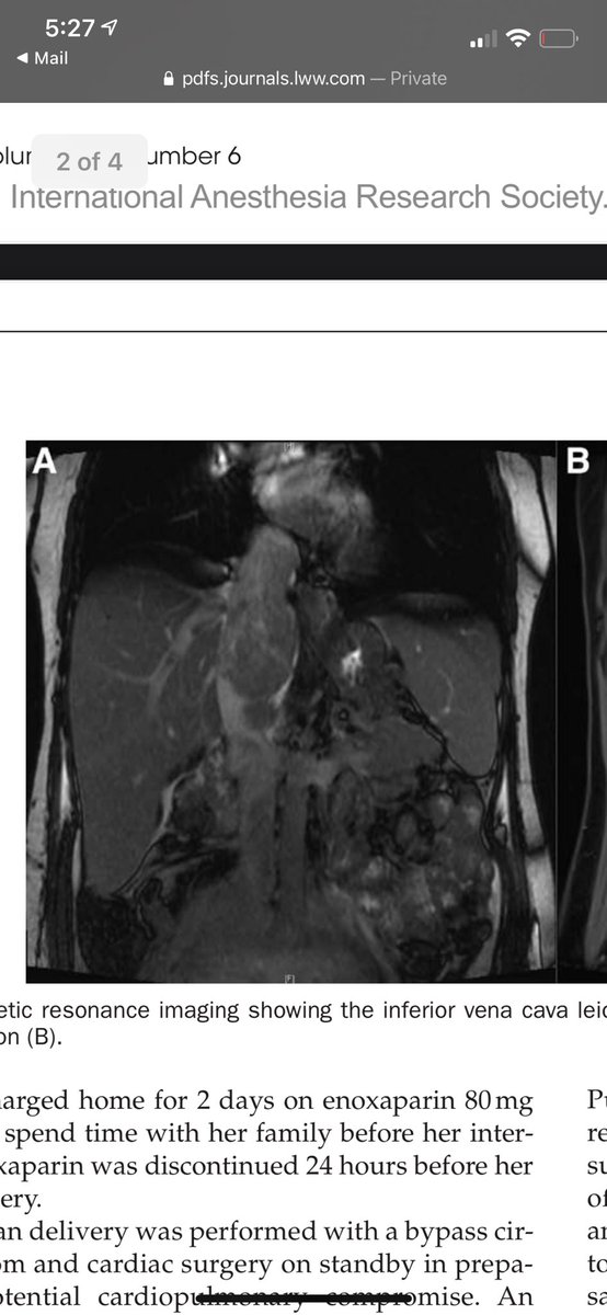 Northwestern OB Anesthesiology (@nu_obanes) on Twitter photo Check out a new case report by <a href="/samanthalumd/">Samantha Lu</a> <a href="/MccroryEmery/">Emery McCrory, MD</a> <a href="/rachel_bandi/">Rachel</a> <a href="/lange_ems/">Elizabeth Lange</a> published in A&A Practice! #OBAnes <a href="/NMAnesthesia/">NM Anesthesiology</a> Check out a new case report by <a href="/samanthalumd/">Samantha Lu</a> <a href="/MccroryEmery/">Emery McCrory, MD</a> <a href="/rachel_bandi/">Rachel</a> <a href="/lange_ems/">Elizabeth Lange</a> published in A&A Practice! #OBAnes <a href="/NMAnesthesia/">NM Anesthesiology</a>