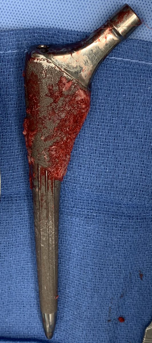 3 states 3 surgeries 3 great outcomes!!  WES delivers total extraction time of 28 minutes for an average of 9 minutes and change!!  #orthotwitter surgeons take credit and retweet!!