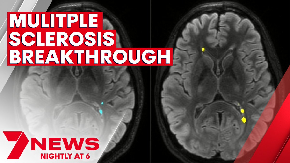 Sydney researchers have created a new global imaging platform making it easier for doctors to detect and possibly predict the symptoms of Multiple Sclerosis. It's paving the way for better treatment options. youtu.be/cyifd-1kahw #MultipleSclerosis #7NEWS