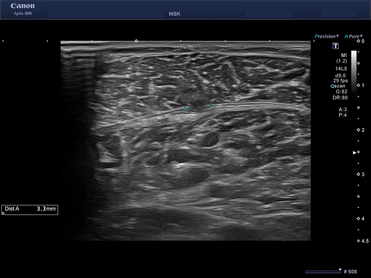 javieryanguas's tweet photo. De acuerdo a la clasificación de lesiones del gastrocnemio medial propuesta por @carlespedret y @Dr_Ramon_Balius aquí una de tipo 2A en la que se aprecia un pequeño gap de la aponeurosis del gemelo interno (<50% del total). 
https://t.co/AV47JnXd9Q https://t.co/f3P98vmvQg