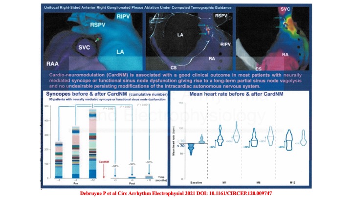 drraviele's tweet photo. Cardio neuromodulation with unifocal right-sided anterior GP ablation is effective & safe in most pts with VVS or functional SND @DrRoderickTung @MDTolgaAksu @Dominik_Linz @CarinaHardy4 @DhirajGuptaBHRS @drrakeshg1 @DrJasonAndrade @adribaran @SABOURETCardio @martinkstiles #CIRCEP https://t.co/R9SJTVgeNd