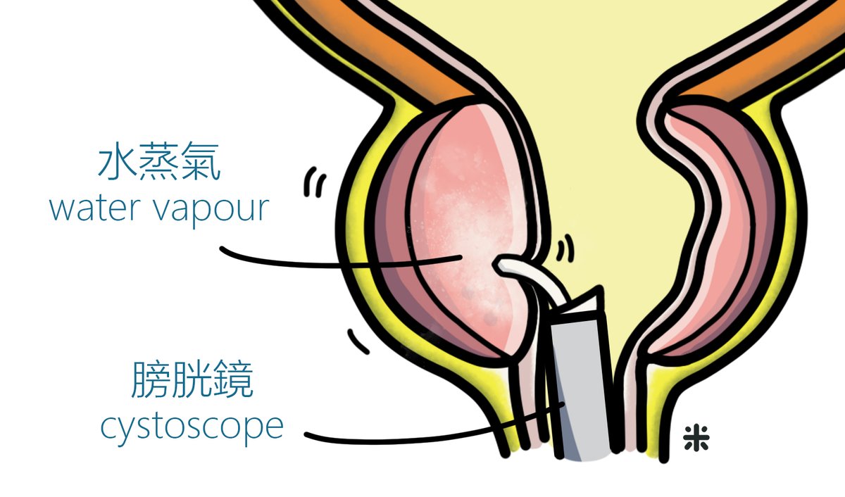 [#CUHKUrology] "Transurethral Water Vapour Therapy" reduces the prostate tissue and volume related to #BPH, relieving lower urinary tract symptoms. Most patients can feel their symptoms improved within two weeks at the earliest. Self-assessment: bit.ly/3uI93bZ