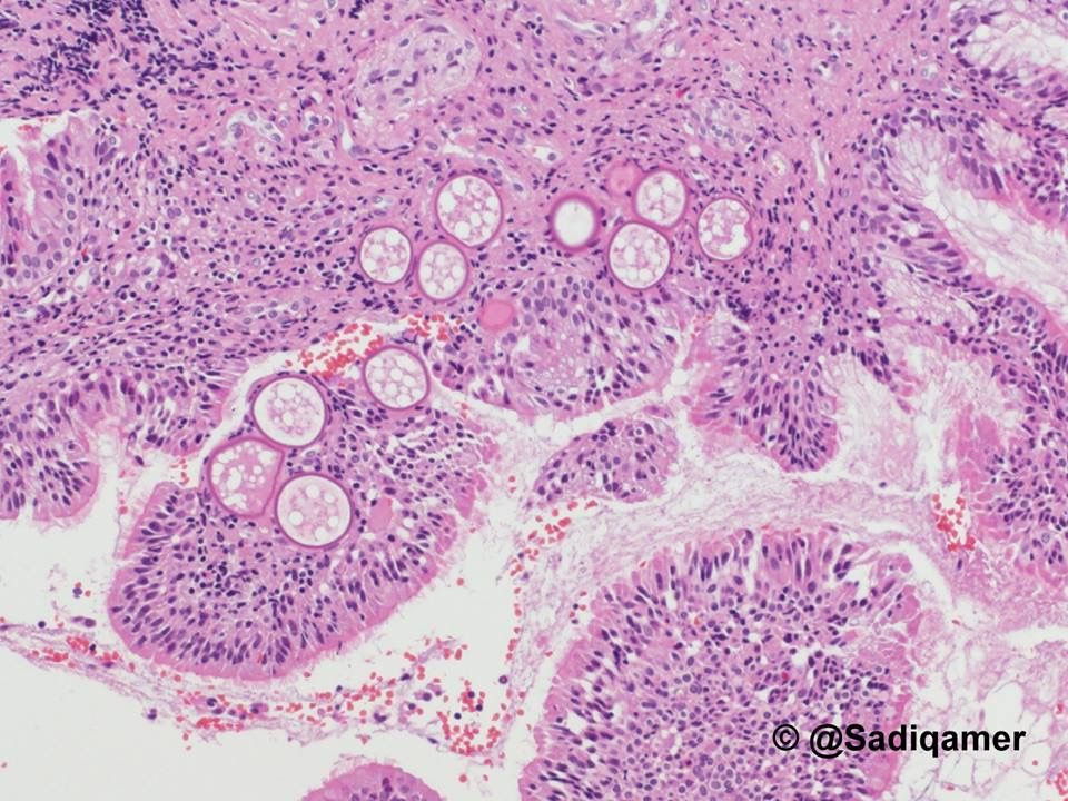 JMGardnerMD's tweet photo. Nasal mucosal mass. Your diagnosis? Answer &amp; more pics here: https://t.co/1mrs23l3PX. Many thanks to @sadiqamer for these incredible images! #pathology #pathologists #pathTwitter #dermpath #dermatology #dermatologia #dermtwitter #ENTpath #microbiology https://t.co/Vyo6vdeB2H