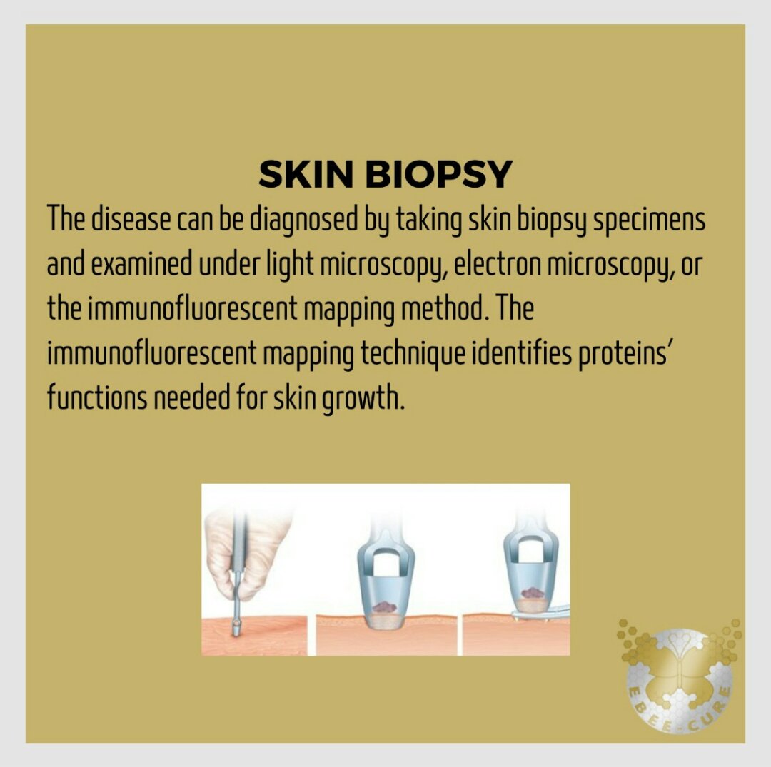 EBee_Cure's tweet photo. #Epidermolizisbülloza #Epidermolysisbullosa #kelebekhastalığı
#butterflydisease #kelebekçocuklar #butterflychildren #ebawareness @RaDiChallenge @CihanTastan_PhD https://t.co/vQ13xUMkvK