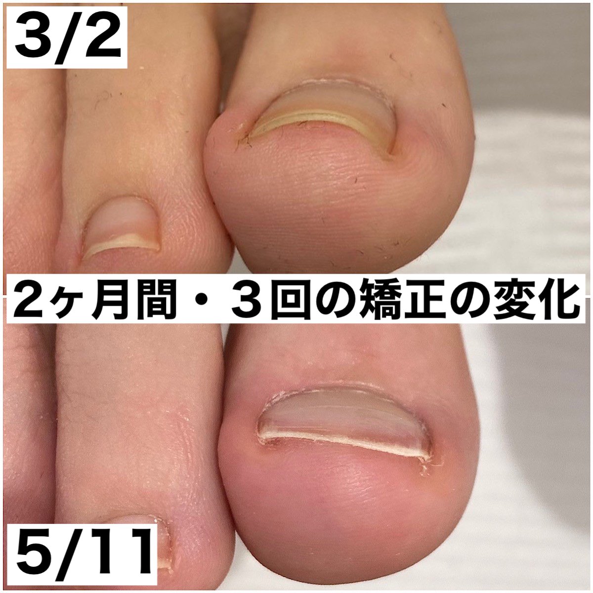 巻き爪サロン Libre Makizumelibre Twitter