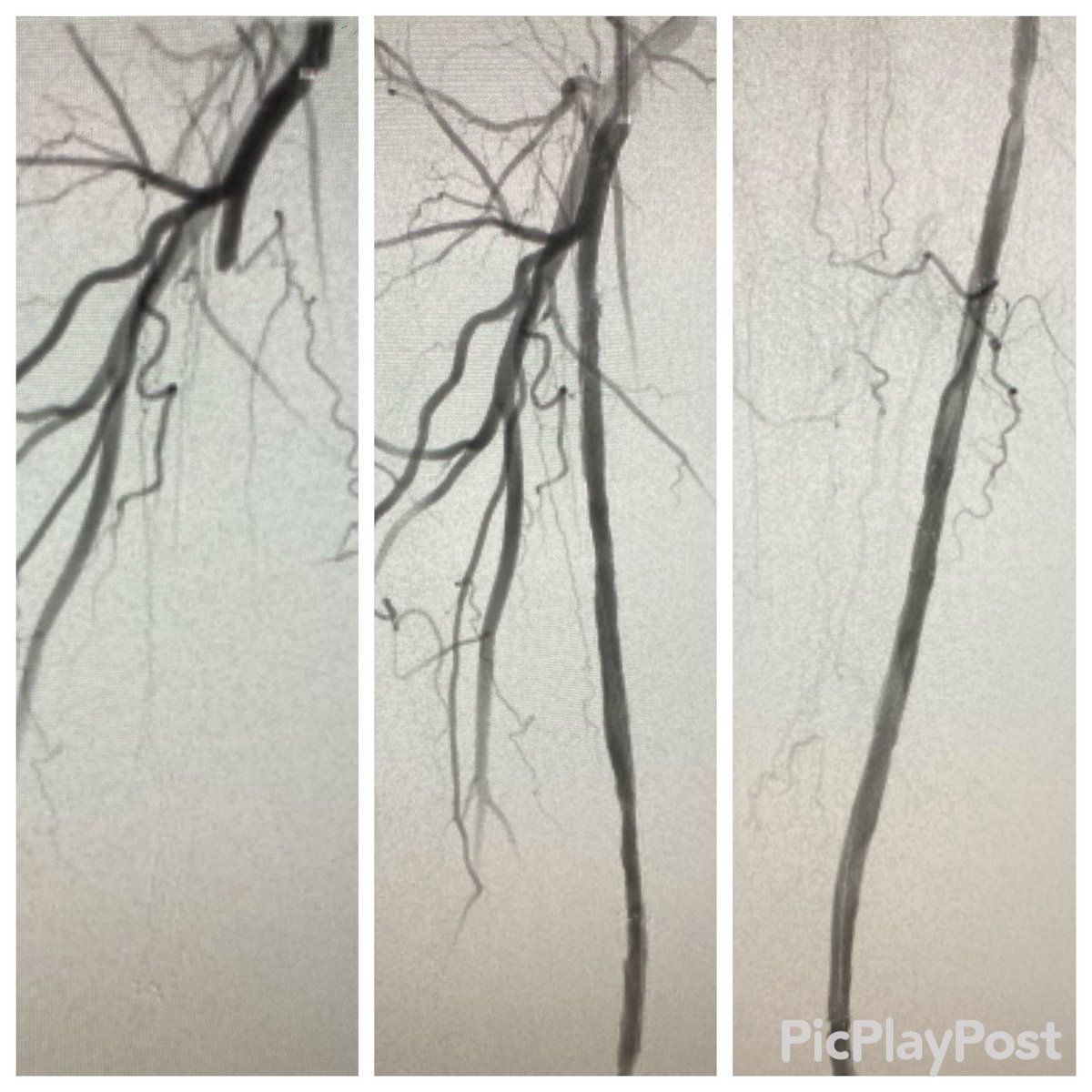 Acute limb ischemia. In-stent thrombosis of SFA/Pop. One pass with Rotarex. Angio prior to DCB. Palpable pulses. Color me impressed. #vascular #irad <a href="/SIR_ECS/">SIR ECS</a> <a href="/SIRRFS/">SIR RFS</a>