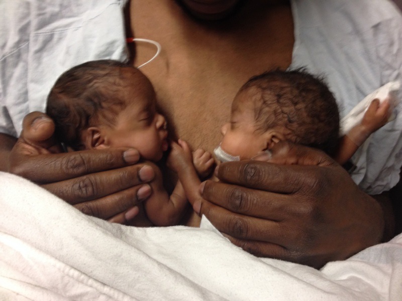 Sunnybrook's tweet photo. Today is National Multiple Births Awareness Day. 👶👶

Twins Asha and Surabhi were born at only 25 weeks, and spent three months being cared for in Sunnybrook’s Neonatal Intensive Care Unit.

Now, they’re thriving six-year-olds! https://t.co/NKb9gVDuju #NMBAD https://t.co/YGx1304b4z