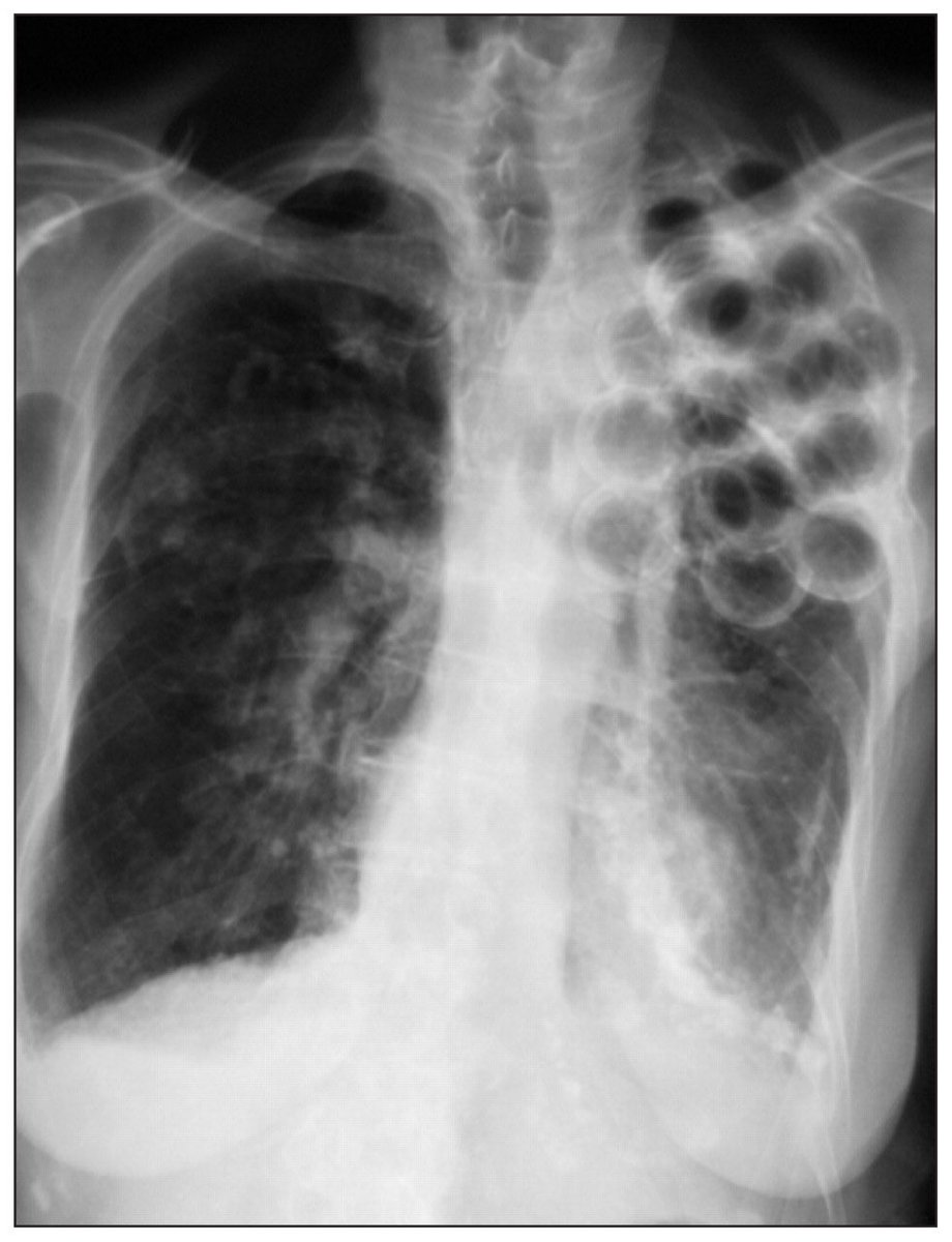 CXR quiz: what’s the diagnosis? The newest generation of MDs may not recognize this. It’s a good example of the desperation of the times and the daring of surgeons. #MedTwitter #Pulmonary #CXR #HistoryOfMedicine