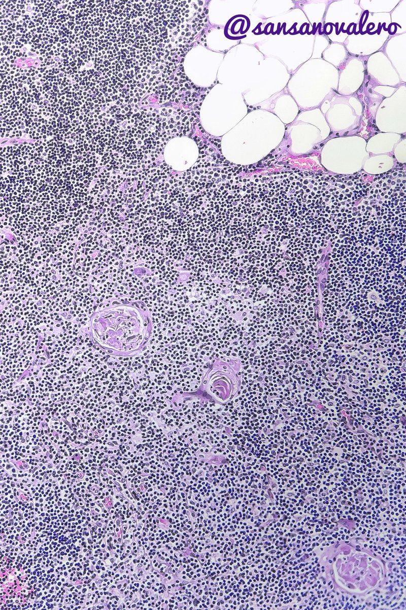 True Thymic Hyperplasia in a 30 yo. Enlargement of normal thymus. Thymic cortices &amp; medullae are well defined. Interstitial connective tissue is delicate with fat cells #pulmpath