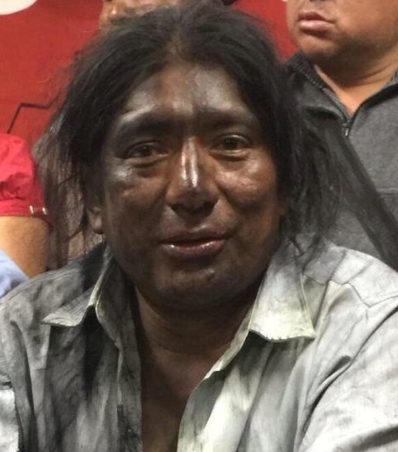 fmcarajo's tweet photo. @elcomerciocom Ya apareció el primer caso de "hongo negro" en América Latina. https://t.co/64vLO1CrDg