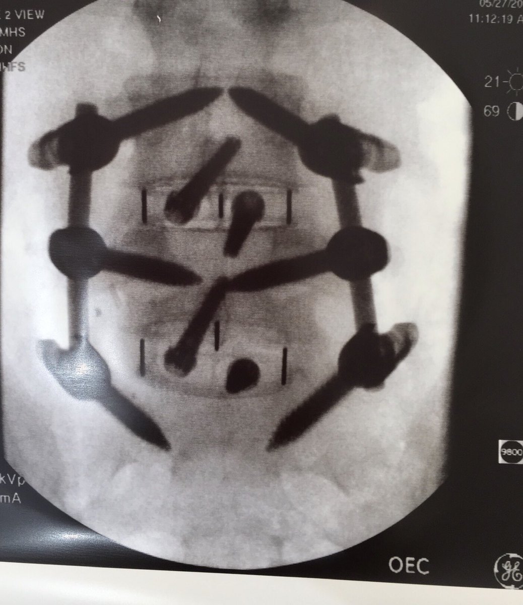 SpanishEagles's tweet photo. My daughter has youth on her side for a quick recovery! I will somehow incorporate this into a #spanish lesson next year. @dailystem this might be something you could use for the newsletter! #stem #medical #vertebralcolumn #fusion #surgery #alif https://t.co/mcz0d0oKOk