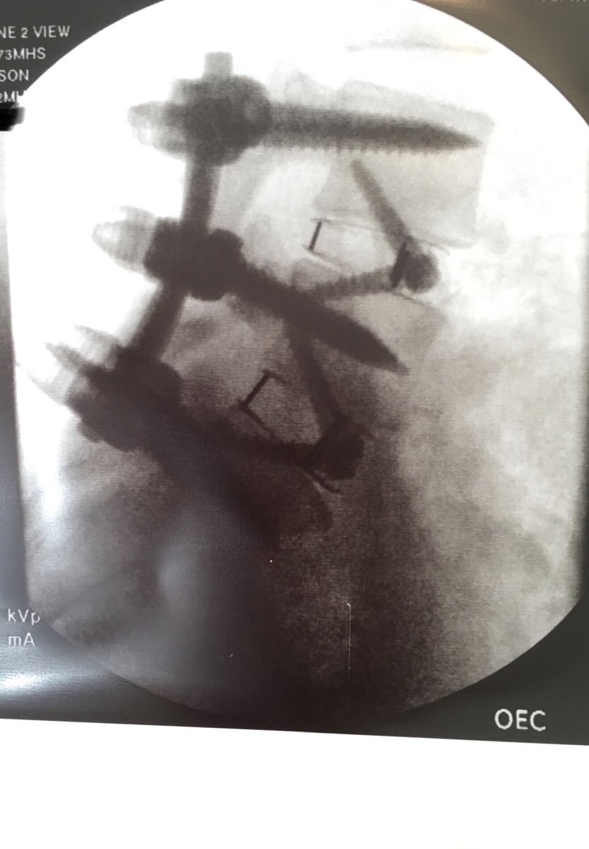SpanishEagles's tweet photo. My daughter has youth on her side for a quick recovery! I will somehow incorporate this into a #spanish lesson next year. @dailystem this might be something you could use for the newsletter! #stem #medical #vertebralcolumn #fusion #surgery #alif https://t.co/mcz0d0oKOk